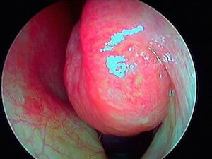 cornet nasal inférieur gauche après décongestionnant