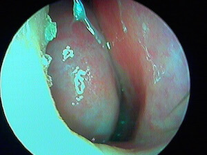 cornet nasal inférieur droit avant décongestionnant