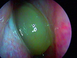 polypose naso-sinusienne fosse nasale droite grade II
