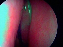 sinsuite maxillaire aiguë pus au méat moyen pus méat moyen gauche SINSUISTE MAXILLAIRE
