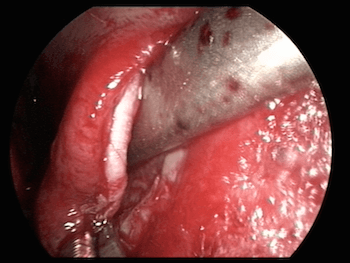 septoplastie endoscopique pour déviation de la cloison nasale