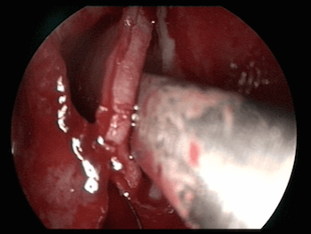 septoplastie endoscopique pour déviation de la cloison nasale