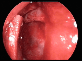 septoplastie endoscopique pour déviation de la cloison nasale