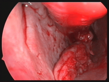 turbinoplastie inférieure gauche au ciseau
