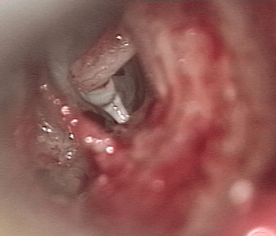 Otospongiose gauchce par Platinotomie section du muscle stapédien