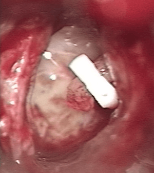 Otospongiose gauche Platinotomie mise en place prothèse
