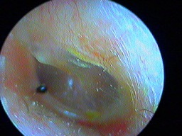 Perforation tympanique gauche inférieure post traumatique refermée spontanément J30 Perforation tympanique gauche inférieure post traumatique J30 refermée