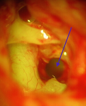 Platinotomie droite insertion prothèse