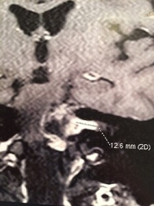 neurinome acoustique gauche en sablier