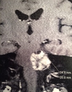 neurinome del'acoustique gauche volumineux grade 4