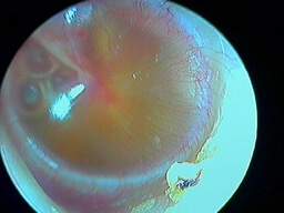 Otite séromuqueuse bulles derrière le tympan