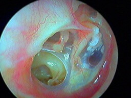 Perforation tympanique postéro-inférieure de l'oreille droite
