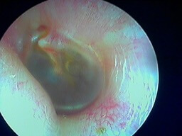 avant paracentèse otite séreuse