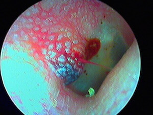 otite barotraumatique avec otohématome et tympan percé