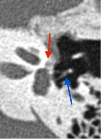 scanner de l'oreille gauche otospongiose