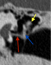 otospongiose gauche après opération scanner des rochers