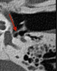 scanner des rochers: otospongiose gauche postopératoire: prothèse téflon en place dans la fenêtre ovale