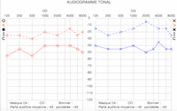 Audiogramme