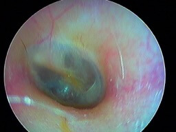 oreille normale gauche en otoendoscopie